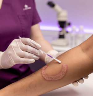 Fungal Viral Bacterial Infection Treatment in Nagpur