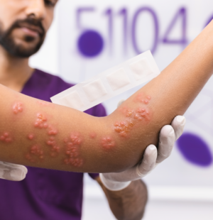 Skin Allergy Urticaria Hives Management in Nagpur