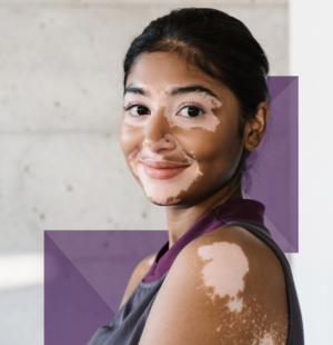 Vitiligo White Patch Therapy in Nagpur